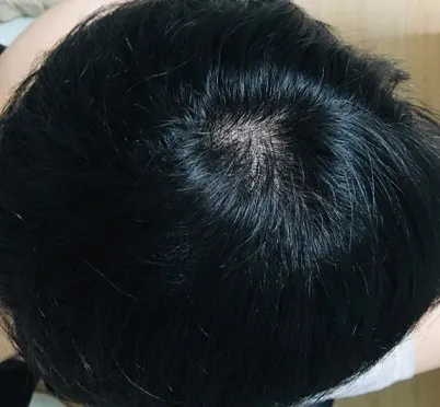 탈모 초기 증상 놓치기 쉬운 5가지 신호 67d7475657ecb.jpg